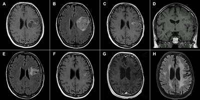 Eighteen years’ experience with tumor treating fields in the treatment of newly diagnosed glioblastoma